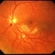 CMV Retinitis